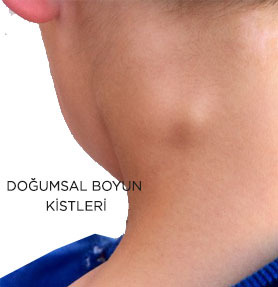 Doğumsal Boyun Kistleri